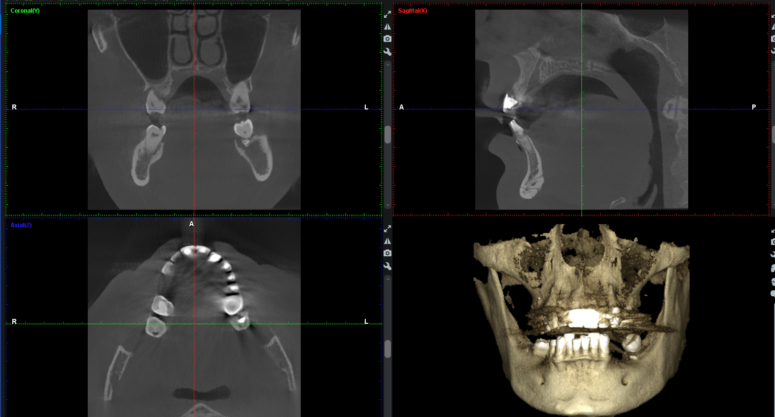 Предимства на дигитално проведена имплантология