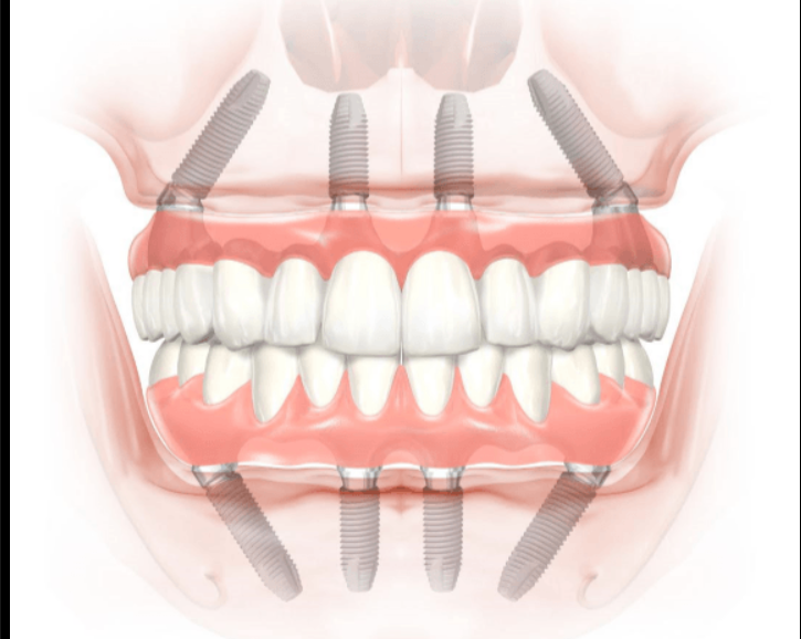 Какво е „All-on-4“ и защо се прилага?