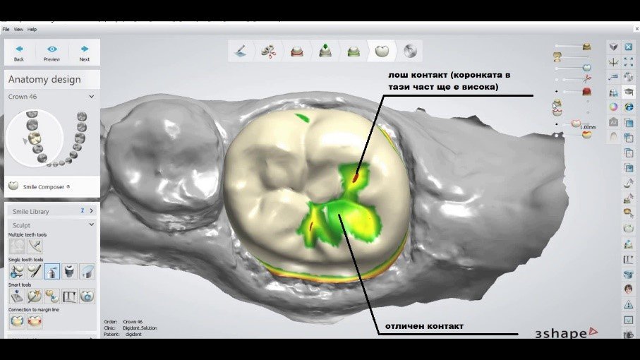 Предимства на дигитално изработената коронка