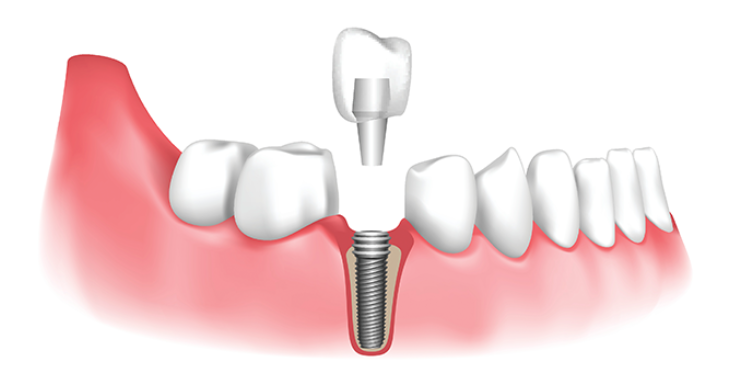 Защо имплантите са толкова успешни?